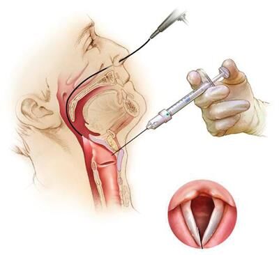 best-vocal-cord-specialist-in-hubli--dr-puneeth-p-j-for-vocal-cord-paralysis-treatment-thumbnail